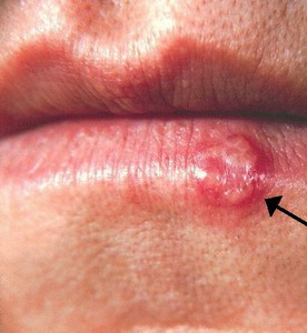 Herpes labialis