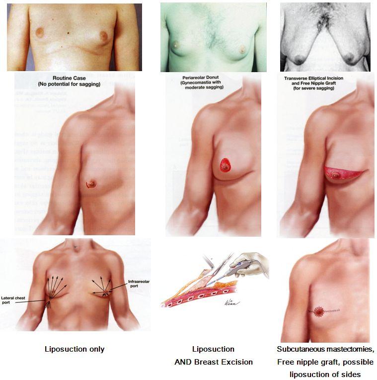 gynecomastia